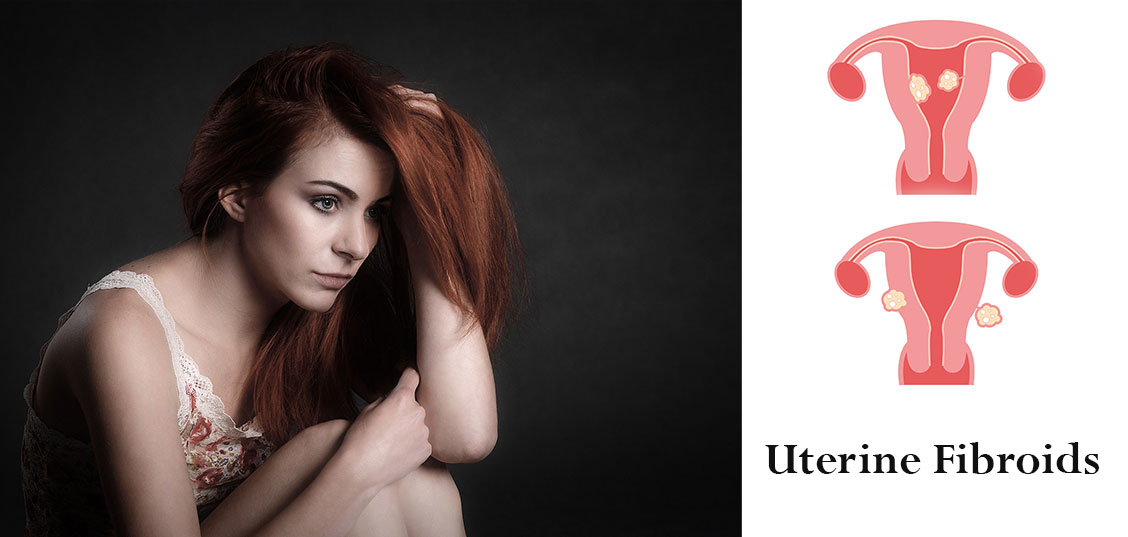 The Symptoms of Uterine Fibroids